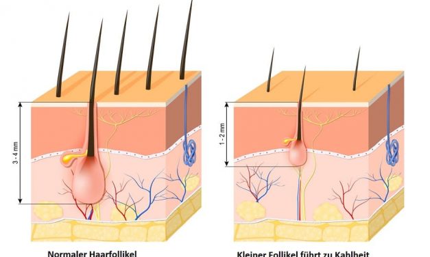 Haarausfall mit Wurzel – ein Alarmsignal