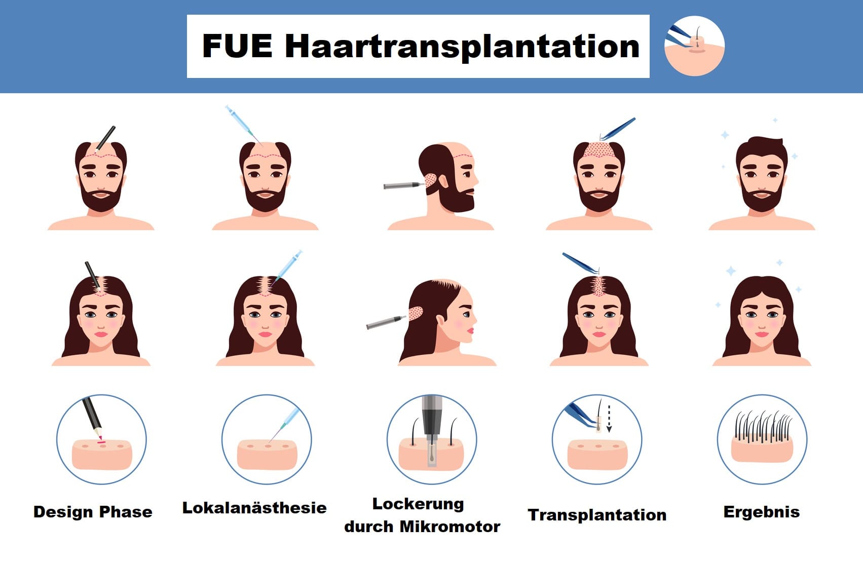 FUE Haartransplantation