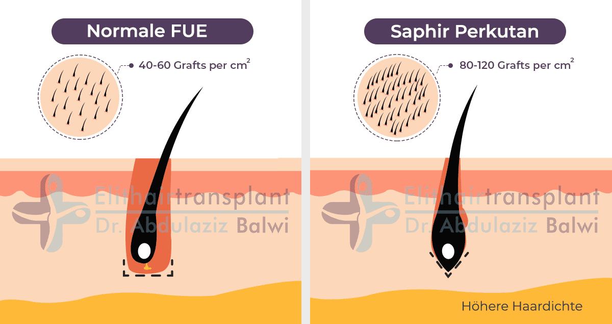 Perkutan Haartransplantation