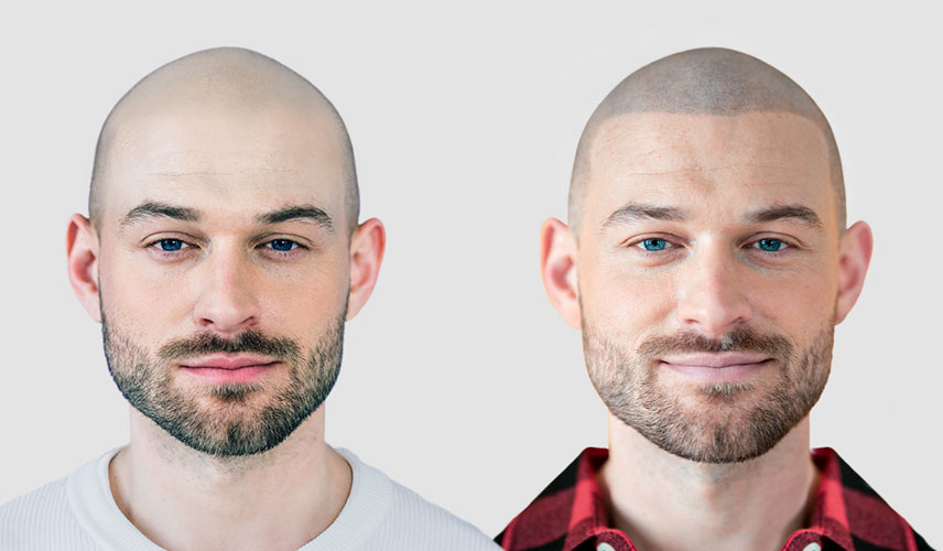 Haarpigmentierung – positive Dr. Pigment Erfahrung der Patienten